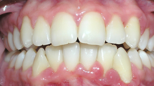 Gingivitis: presencia de inflamación gingival sin pérdida de hueso alveolar pero con cambios en la encía de color, tamaño, contorno, forma, textura, consistencia y posición por la acumulación gingival de placa bacteriana y/o cálculo