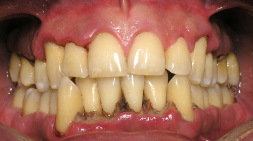 Presencia de inflamación gingival con pérdida de hueso alveolar. Acumulación de placa i cálculo supra y subginvial. Cambios de topografía de la superficie gingival con movilidad dentaria en casos avanzados.